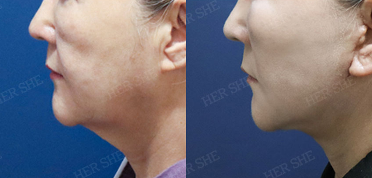 Perbandingan Sebelum & Sesudah Shoulder Contouring