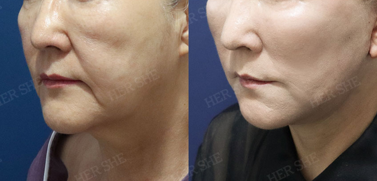 Perbandingan Sebelum & Sesudah Shoulder Contouring