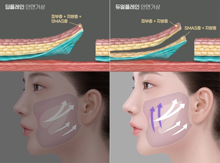 Poin Utama HERSHE Dual Plane Facelift