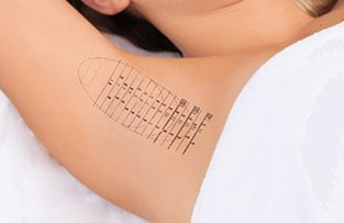 미라드라이 시술 범위 디자인